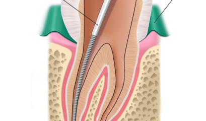 What Is A Root Canal