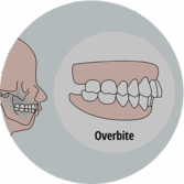 Overbite Diagram