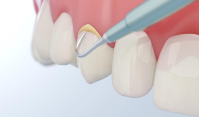How To Get Rid Of Plaques
