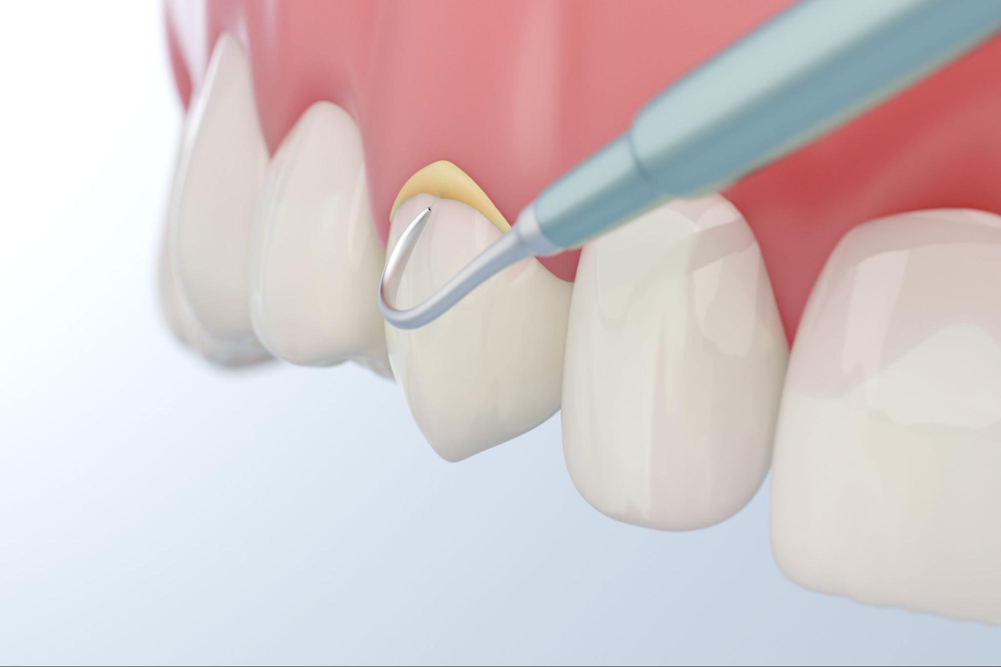 How To Get Rid Of Plaques